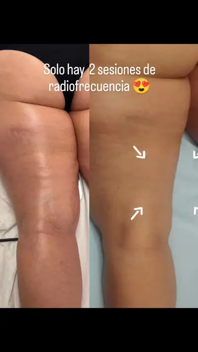 Piernas, antes y después