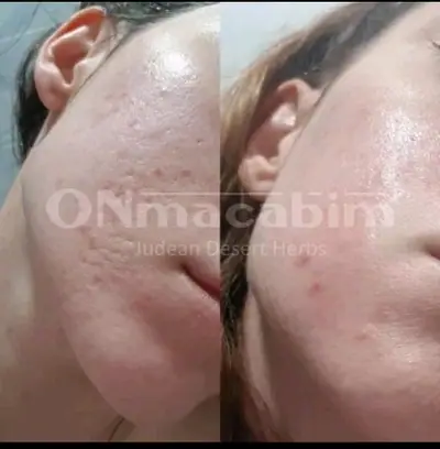 Tratamiento de piel