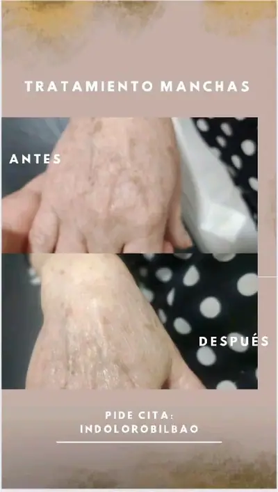 Antes y después de piel